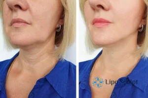 Double chin before and after Hi-Fu treatment 4 Book your double chin treatment Sandwich today! We are here to help!