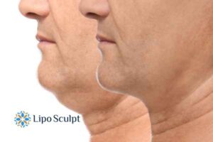Double chin before and after Hi-Fu treatment 2 Double chin treatment Sandwich from Lipo Sculpt - feel more confident today!