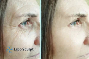 How to Fight Aging Symptoms 2 Do you want to Fight Aging Symptoms Sandwich? Contact Lipo Sculpt today!