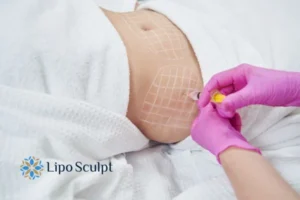 Are The Results From Aqualyx Permanent? 1 Do you want to know how long Aqualyx Sandwich results last?