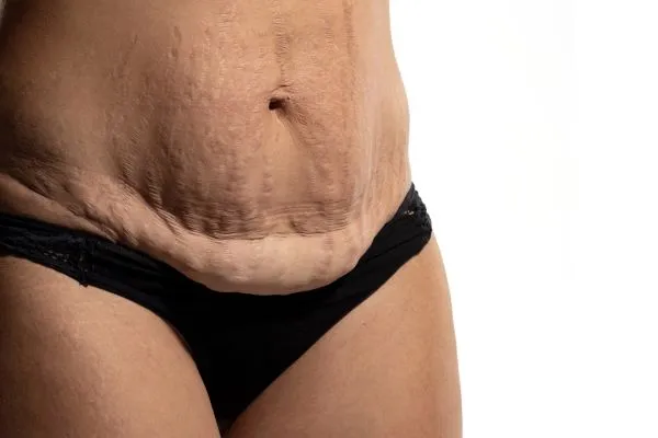 Lost the Weight but Not the Loose Skin? 1 image of womans stomach after weight loss showing loose skin Sandwich